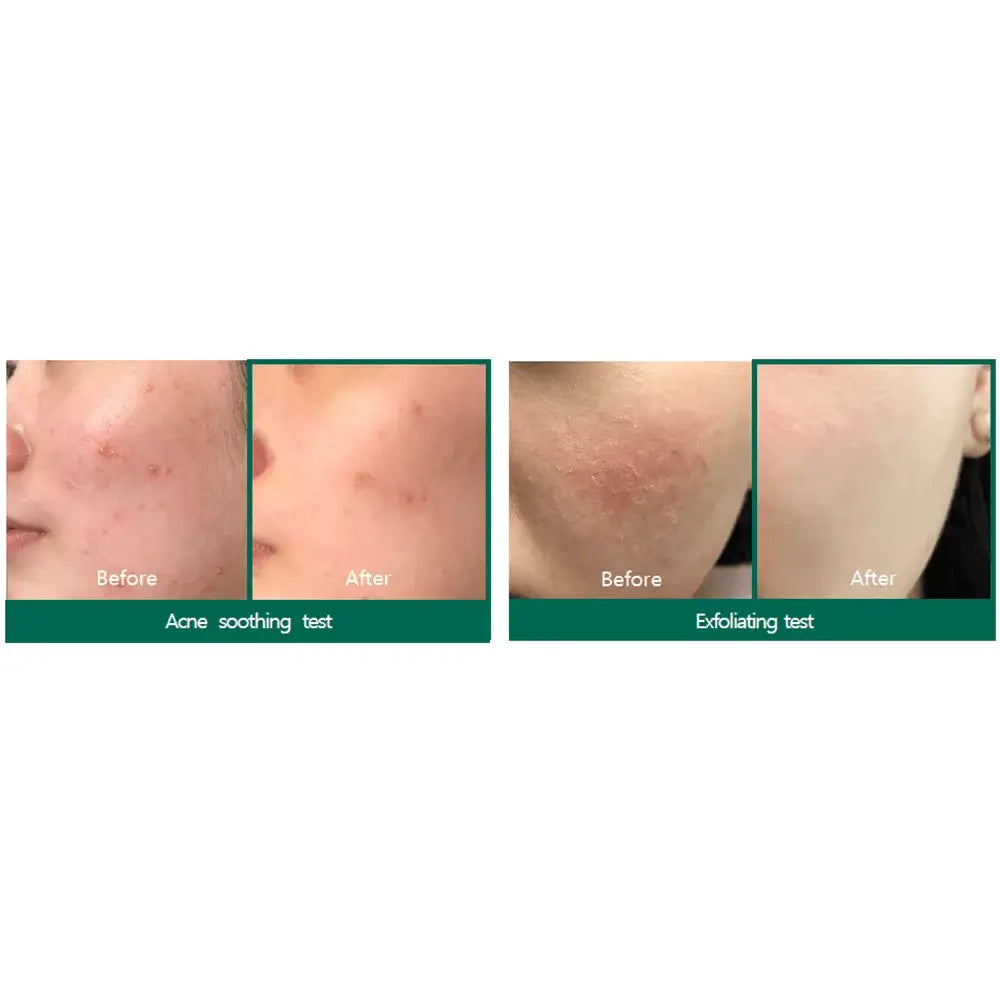 SOMEBYMI AHA-BHA-PHA Miracle Acne Clear Foam 100ml